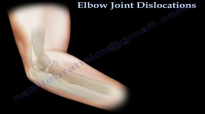 Elbow Dislocations  Everything You Need To Know  Dr. Nabil Ebraheim