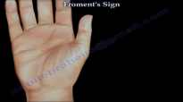 Froments Sign  Everything You Need To Know  Dr. Nabil Ebraheim